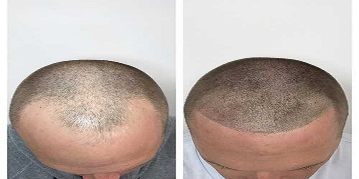 How Scalp Micropigmentation Works and Why It's a Helpful Hair Loss Solution